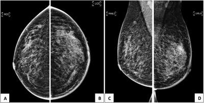 Breast metastasis from endometrial clear cell carcinoma: A case report and review of the literature